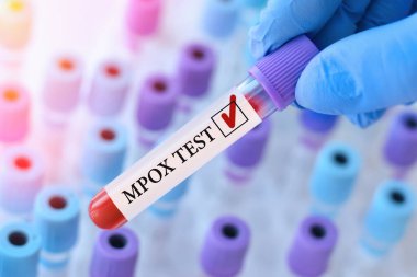 Doctor holding a test blood sample tube with Monkeypox virus (MPXV) .The virus is transmitted from animals to humans. Infected people suffer from fever, cough, headache, nausea and vomiting