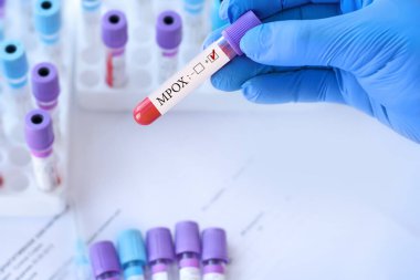 Doctor holding a test blood sample tube with Monkeypox virus (MPXV) .The virus is transmitted from animals to humans. Infected people suffer from fever, cough, headache, nausea and vomiting