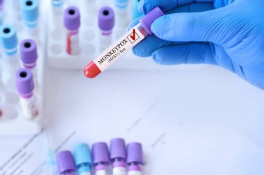 Doctor holding a test blood sample tube with Monkeypox virus (MPXV) .The virus is transmitted from animals to humans. Infected people suffer from fever, cough, headache, nausea and vomiting