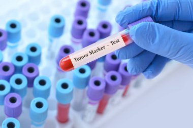 Analizli tıbbi test tüplerinin arka planında tümör işaretleyici testi olan bir test tüpü tutan doktor..
