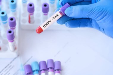 Analizli tıbbi test tüplerinin arka planında insan metafnömotorirüs virüsü testi yapılan bir test tüpü tutan bir doktor. İnsan Metapnömotorirüsü, HMPV virüsü.