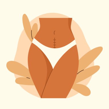 Cesarean scar. Stitches after caesarean section on female belly. C-section, surgical delivery operation concept. Vector illustration in cartoon style. Isolated white background. clipart