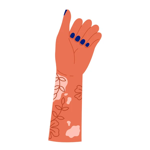 Kvinna Hand Med Vitiligo Blommig Tatuering Och Manikyr Vitiligo Hud — Stock vektor