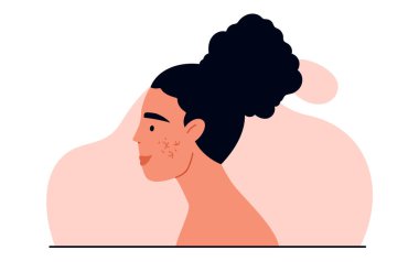 Couperose konsepti. Rosacea ya da kadın yüzünde yüzeysel kılcal damarlar. Yüz kızarıklığı. Dermatoloji ve cilt bakımı. Çizgi filmdeki izole vektör çizimi