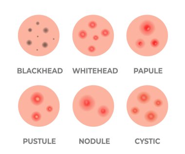 Types of acne illustration. Pimples, skin pores, blackhead, whitehead, scar, comedone. Skincare problems and inflammation. Acne skin types - blackheads, whiteheads, papules pustules cystic nodular