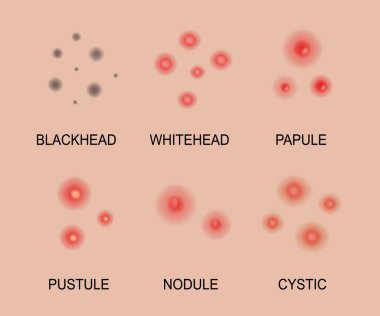 Farklı sivilceler. Sivilceli tipler, siyah noktalar, beyaz noktalar, papüller, kabarcıklar, kistik ve nodüler. Cilt sorunları ve iltihap. Yaraları olan iltihaplı bir cilt.