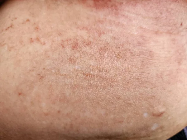 Dermatite Atopica Una Malattia Infiammatoria Cronica Della Pelle Ereditariamente Predisposta — Foto Stock