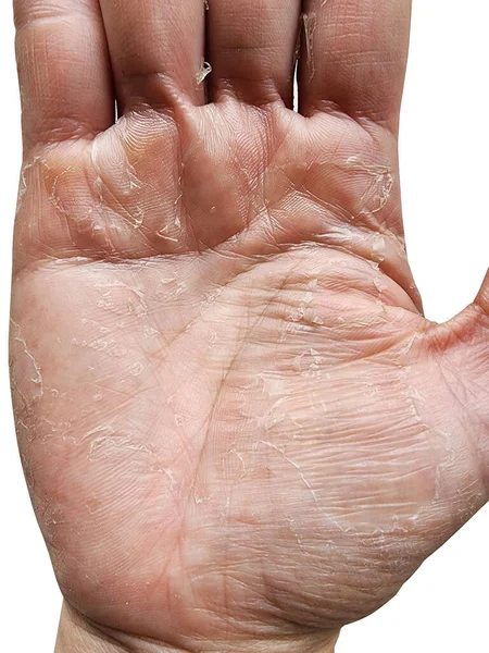 Les Allergies Sont Cause Eczéma Des Mains Dermatite Inflammatoire Lavage — Photo