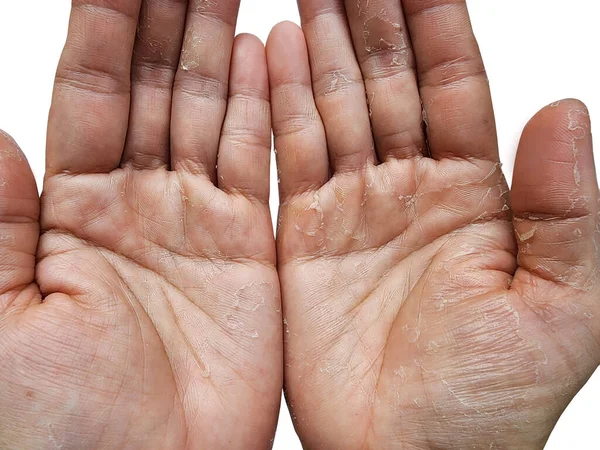 Alergias São Causa Eczema Manual Dermatite Inflamatória Lavagem Das Mãos — Fotografia de Stock