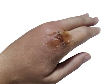 Eli bir bıçakla kesilmiş ve iltihaplanmış, şişmiş ve çürüğe dönüşmüş. Ve bir yara izi olabilir. beyaz arkaplanda