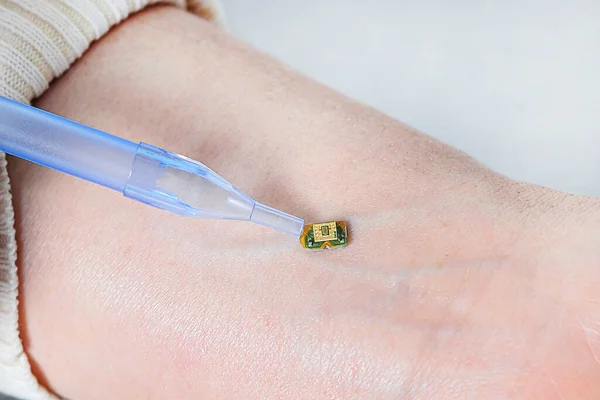 A small microcircuit lies on the wrist of a human hand, is pressed by a medical instrument next to a vein, Health Modification Control by Nanotechnology. Chip installation process. Health correction