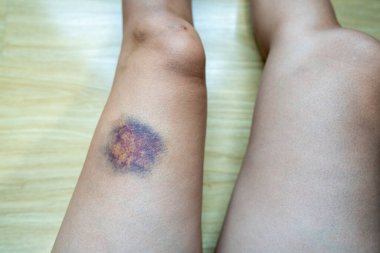 Kadın bacağında çürükler, kaza..