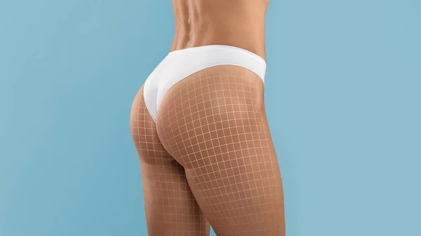 Cellulite Mesotherapy Cropped Shot Perfect Female Buttocks Drawn Mesh Unrecognizable — Stock Photo, Image