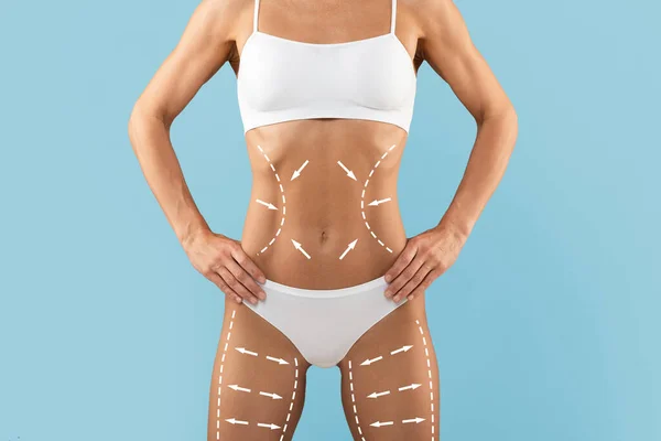 Leczenie Liposukcji Przycięty Strzał Szczupłej Młodej Kobiety Ciała Narysowanych Linii — Zdjęcie stockowe