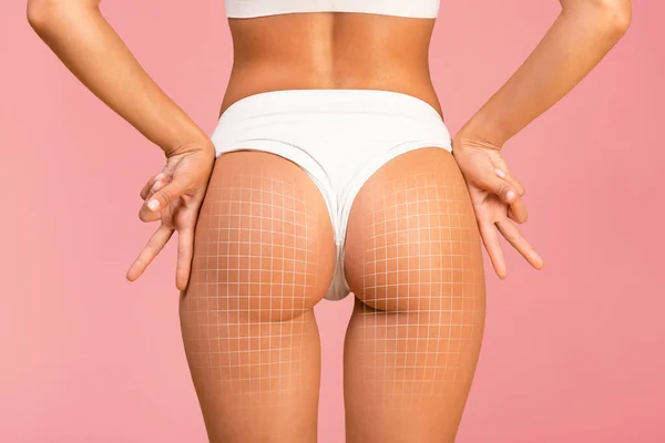 Butt Lift. Slim Female With Perfect Buttocs And Drawn Mesh On Skin Posing Over Pink Background, Rear View Of Young Fit Woman In White Underwear Demonstrating Result Of Aesthetic Treatment, Collage