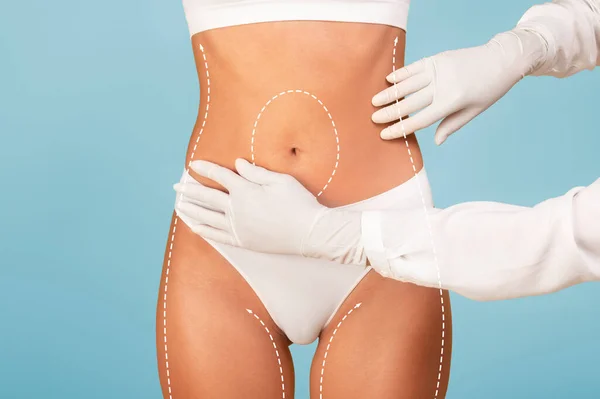 Begreppet Plastikkirurgi Läkare Inspektera Kroppen Kvinnliga Patienten Före Fettsugning Behandling — Stockfoto