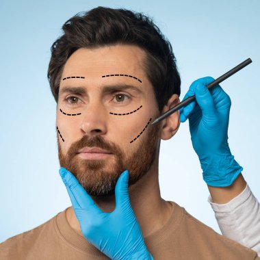 Middle aged man getting pencil marks on face skin for cosmetic surgery, ready for operation, plastic surgeon applying marks on male face before surgery, blue background, cropped