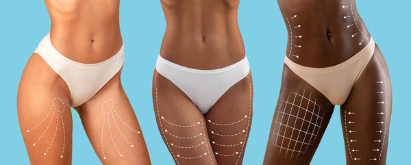 Миллениальные смешанные расы, европейские, черные дамы в бикини с тонким телом с линиями для формирования фигуры, дренажный массаж изолирован на синем фоне. Липосакция, контурная пластика, косметология