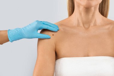 The doctors gloved hand checking mole nevus on unrecognizable womans shoulder, isolated on grey studio background. The concept of moles and skin cancer concept, cropped clipart