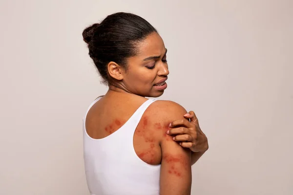Sensitive Skin, Food allergy symptoms, Irritation. Annoyed young african american woman scratching red spots all over her body, isolated on grey studio background, copy space, back view