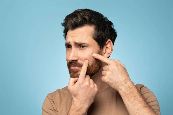 Homem Meia Idade Barbudo Tocando Seu Rosto Removendo Cravos Pressionando — Fotografia de Stock