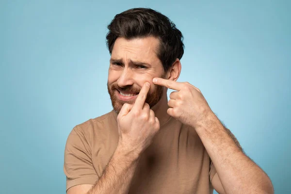 Frowning Middle Aged Man Popping Inflamed Pimple Face Looking Camera — Stock Photo, Image