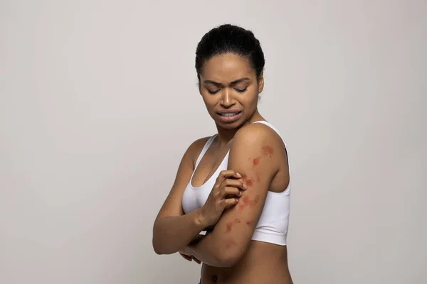 Piel Sensible Síntomas Alergia Alimentaria Irritación Eczema Mujer Afroamericana Joven — Foto de Stock