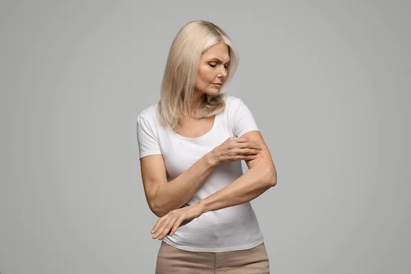 银屑病穿着白色T恤衫的成熟女人在手臂上抓挠恼怒的皮肤 年长女人在身体上瘙痒的皮疹 站在灰色工作室的背景上 — 图库照片