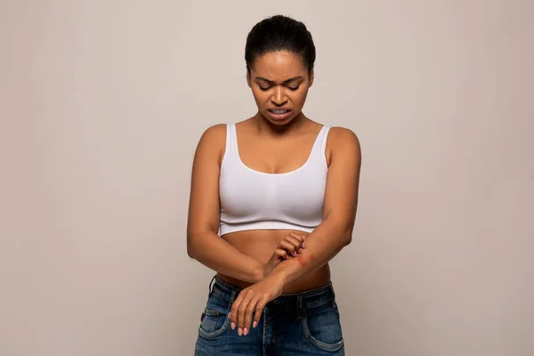 Sensitive Skin, Food allergy symptoms, Irritation, Dermatitis. Annoyed young black woman scratching red spots on her arms hands, isolated on grey studio background, copy space