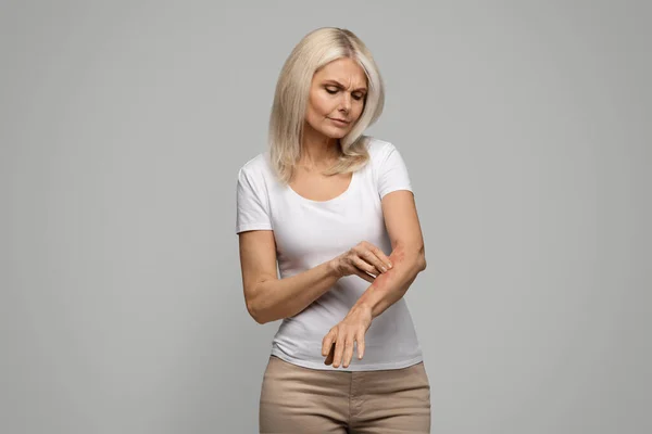 Ongelukkig Volwassen Vrouw Krabben Haar Geïrriteerde Huid Arm Geïrriteerde Oudere — Stockfoto