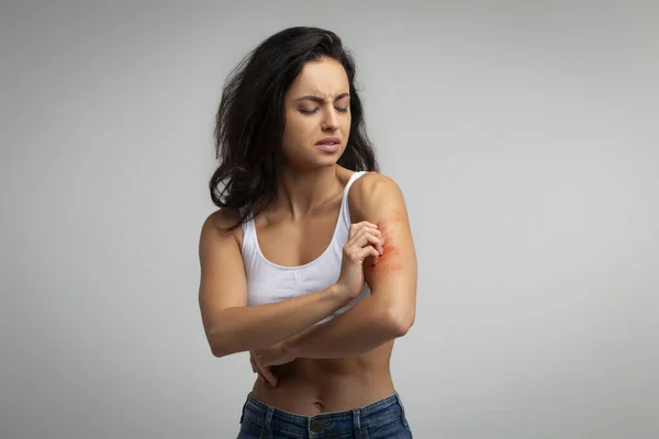 Sensitive Skin, Food allergy symptoms, Irritation, Dermatitis. Annoyed young indian woman scratching red spots on her arm shoulder, isolated on grey studio background, copy space