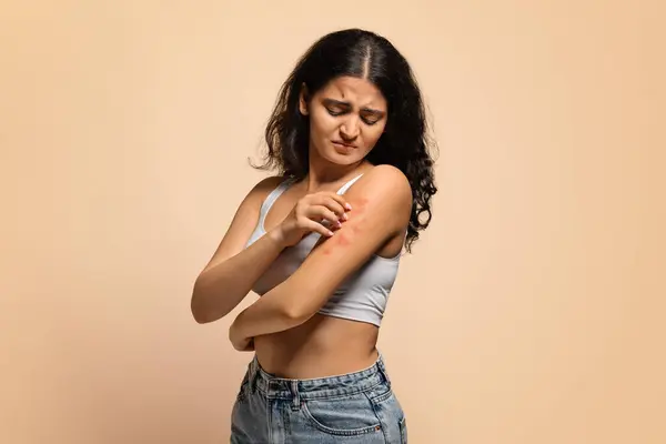 stock image Dermatitis, eczema, allergy, psoriasis concept. Annoyed young indian woman scratching irritated skin on arm, eastern female having itching rash on body, standing on beige studio background