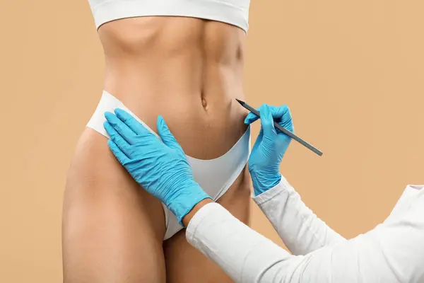 Læge Tegning Mærker Kvindelig Mave Forberedelse Til Kosmetisk Kirurgi Operation - Stock-foto