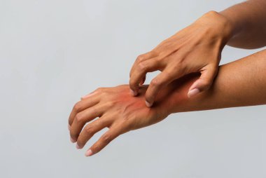 Elini kaşıyan afro bir kadın sedef hastası, gri bir geçmişi var.