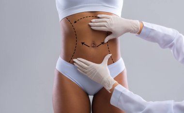 Cellulite removal plan. Doctor hands in gloves marking lines on young afro woman body, grey background