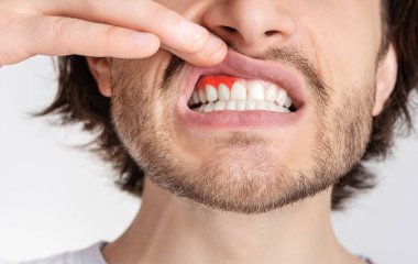 Gingival iltihap ve diş sorunları. Adam acıdan kıvranıyor, dudağını itiyor ve kırmızı sakız gösteriyor, yaklaş, panorama, kesilmiş