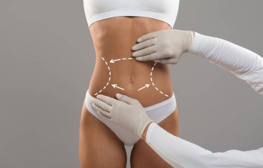 Body Contouring Concept. Unrecognizable Doctor Wearing Gloves Touching Female Body With Marked Lines In Abdomen Zone, Woman Patient Preparing For Liposuction Plastic Surgery, Cropped Shot