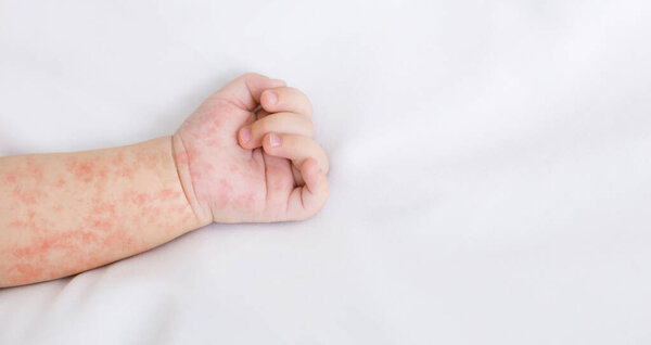 Hand of newborn baby with measles rash on white sheet, closeup, panorama with free space