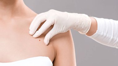 Dermatolog kadın vücudundaki doğum lekesini inceliyor, yakın plan. Kanser önleme kavramı, gri arkaplan