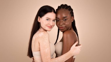 Farklı bir güzellik. Vitiligo Bozukluğu olan genç siyahi kadın ve kadın stüdyoda bej arka planda poz veriyorlar, vücutları çok ırklı, sutyen takıyor ve kameraya gülümsüyorlar.