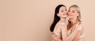 Mutlu Artı Boyut Kadın ve Vitiligo Teni Birbirine Sarılmış Kadın, Bej Stüdyo Arkaplanı üzerinde poz verirken iç çamaşırı giyen iki neşeli kadın portresi,