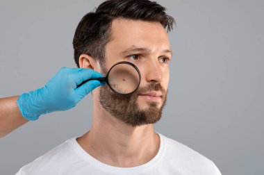 Cilt kanseri konsepti. Dermatoskobu olan orta yaşlı bir adamın cildini kontrol eden Doktor El, gri stüdyo arka planı, kopyalama alanı. Dermatolog sakallı adamı kontrol ediyor, yüzündeki beni tarıyor.