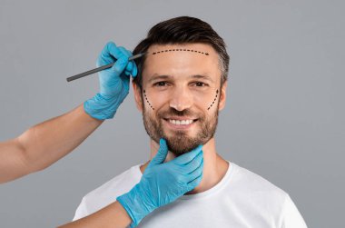 Gülümseyen adam estetik ameliyat için cildinde kalem izi bırakıyor, ameliyata hazır. Estetik Kozmetik Konsepti. Estetik cerrah ameliyattan önce erkek yüzünde izler bırakıyor.