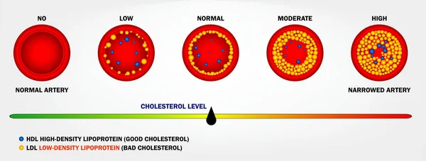 Realistický Typ Cholesterolu Izolované Tepně Eps Vektor — Stockový vektor