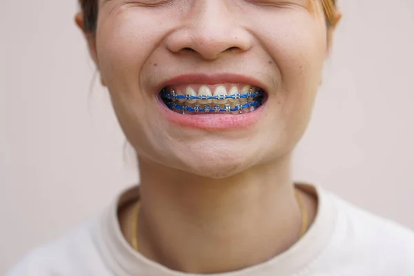 Asian woman smiling showing braces