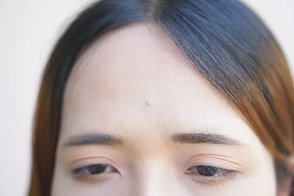 Acne Testa Uma Mulher — Fotografia de Stock