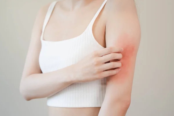 Concepção Alérgica Pele Sensível Mulher Comichão Braço Tem Uma Erupção — Fotografia de Stock