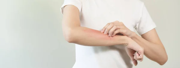 Людина Має Червону Висипку Руці Від Укусу Комахи Алергія — стокове фото
