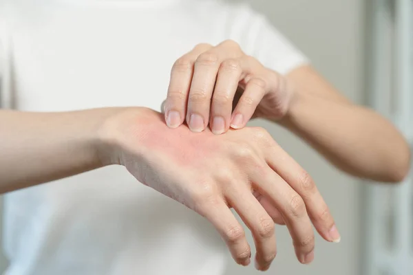 Person Have Red Rash Arm Insect Bite Allergic — ストック写真