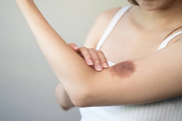 Woman Get Injured Have Bruised Her Arm — Stock fotografie